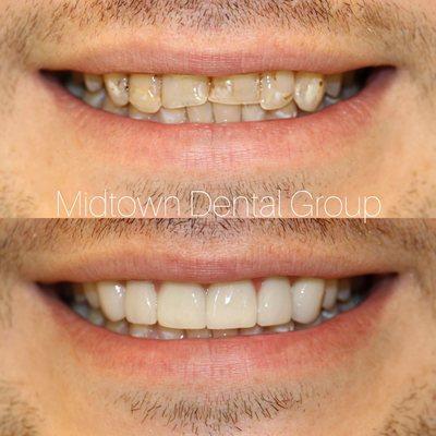 Veneers making a big difference.