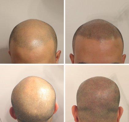 SMP Treatment in Clovis