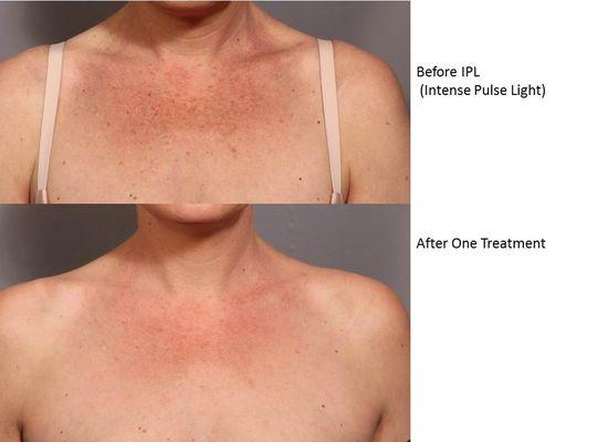 IPL our Nurse preformed on a patient at our Oakland office. Amazing results