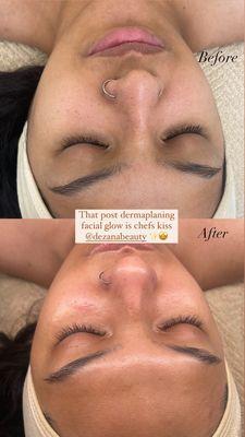 Dermaplaning Facial. 
A physical form of exfoliation that removes dead skin along with unwanted vellus aka "peach fuzz" facial hair.