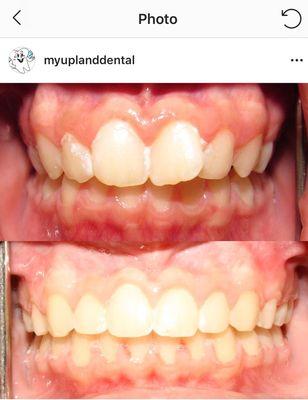 Braces helped achieve this beautiful straight smile!