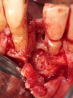 Lateral periodontal cyst