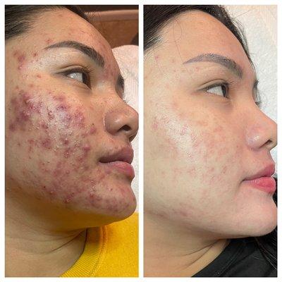 Before/after  almost completely done just a couple more treatments to get rid of the pigmentation the acne caused