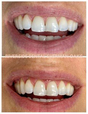 Minimally invasive bonding to repair small imperfections on the teeth.