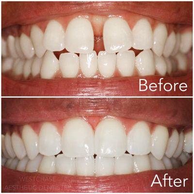 6 month Invisalign case followed by composite bonding, completed by Dr. Stapleton.