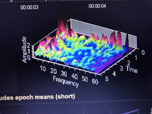 NeuroFeedback After Session Patient Relax