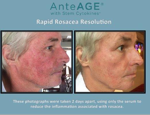 Human stem cell treatment for rosacea