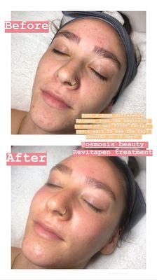 Before and after of the Osmosis Facial Infusion treatment! Instant Results!