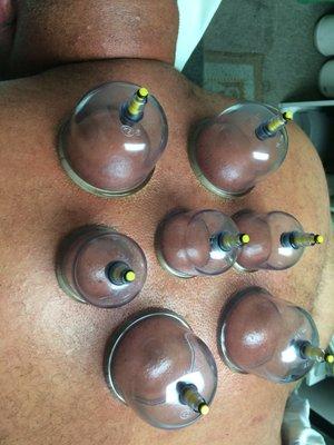 Cupping Therapy