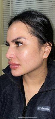 Botox,under eye fillers,chin lips and jaw