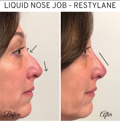 Liquid nose job before and after results.