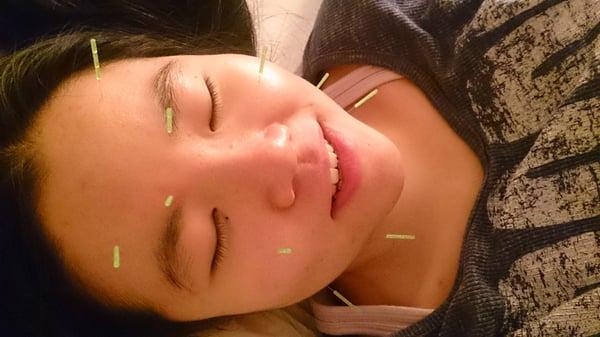 A client getting facial acupuncture.