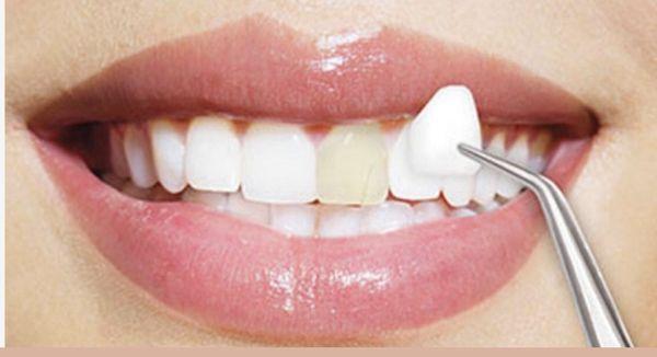 Cosmetic tooth bonding