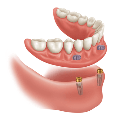 Implant "snap-in" denture, using Locator abutments