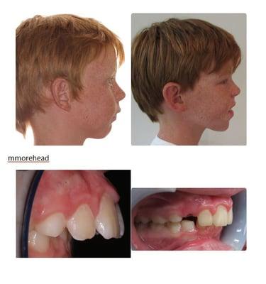 Benefits of early treatment is shown here, and promoted by Miller Orthodontics