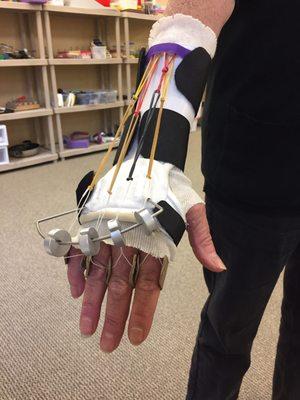 Custom Dynamic extension splint for arthritis joint replacements.