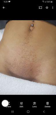 After Brazilian Wax