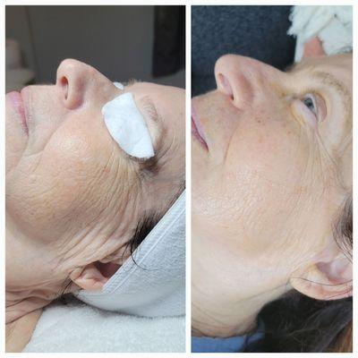 Results after one facial using Osmosis Facial Infusion with Revitapen