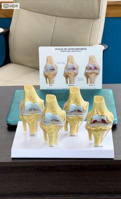 Breakdown on how to remediate osteoarthritis