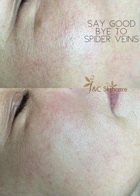 Spider veins removal