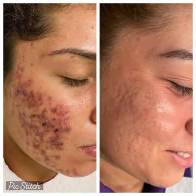 Cystic Acne Treatment with Scar Removal