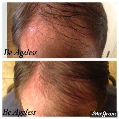 2 months post 1 PRP hair restoration treatment along with prescription topical to restore and prevent further hair loss. 2 more to go...