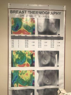 Breast Thermography (Cancer Consultation)