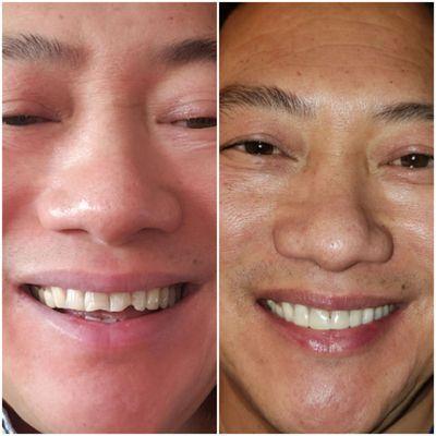 Before and after by Dr. Steven Chen and his fabulous staff.