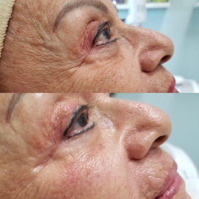 Anti-aging treatment... Get amazing results after your first treatment. This produces collagen for 30 days!