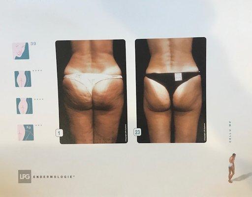 Endermologie Reduce Cellulite