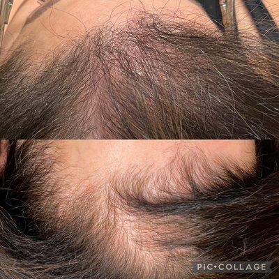 PRP scalp treatments