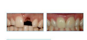 Before & After Our Dental Procedures!
 
 Before: Patient needs a Single Tooth Replacement of one Upper Central Incisor.