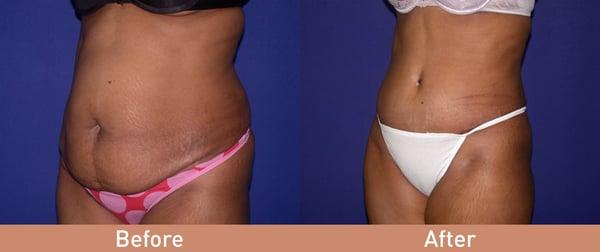 Tummy Tuck