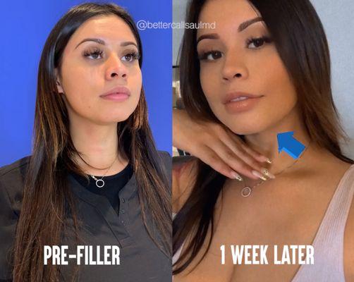 Chin Filler Before vs. After | Revive Face Body Skin