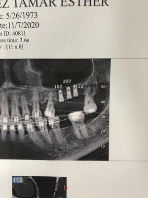 Post-op CT of 3 implant immediate placement case.