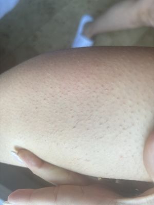 Tons of painful ingrowns from inexperienced waxer