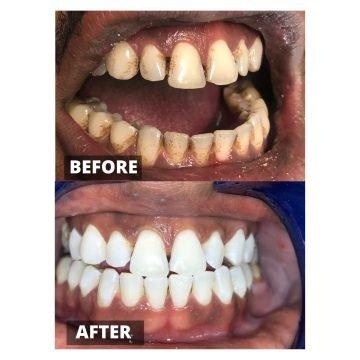 Before and after teeth whitening treatment