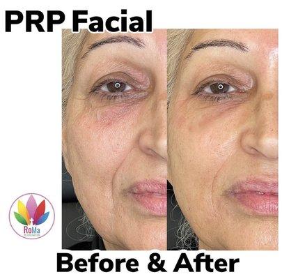 PRP treatments in Riverside California for Skin