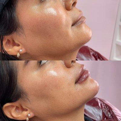 Dermal Fillers were used here with this patient in her smile lines, lips, and chin. Her jawline has dramatically enhanced her jawline.