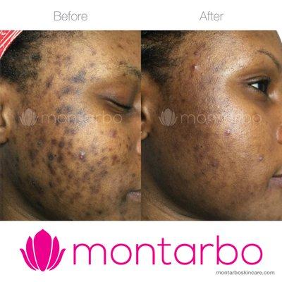 Ethnic skin brightening treatment