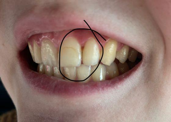 Closer view of gapping and hole in incisors.