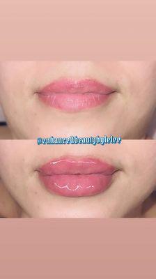 Lip fillers