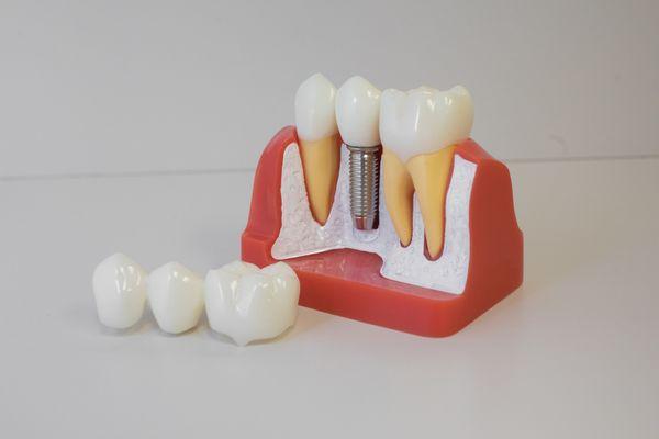 Implant supported crowns and bridges