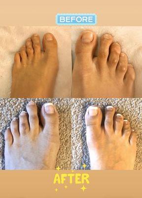 Surgery hammer toe repair