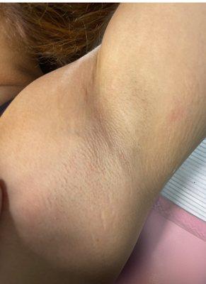 Under arm sugaring