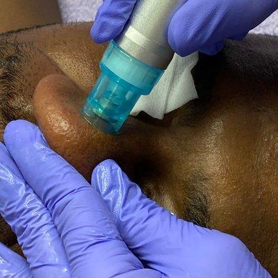 hydrodermabrasion extractions