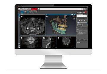 We use CBCT scanning and 3D technology to accurately plan your implant case