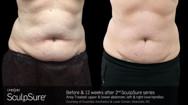 Sculpsure treatment