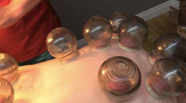 Cupping Deep tissue massage