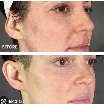 After 3 sessions or secret RF microneedling